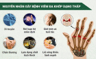 Chữa Viêm Đa Khớp Dạng Thấp Rất Nhanh Hiệu Quả