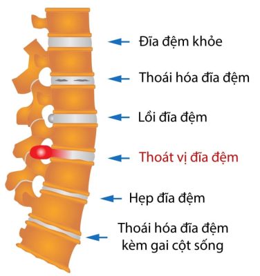 Điều trị thoát vị đĩa đệm: Ứng dụng công nghệ khoa học tiên tiến vào điều trị