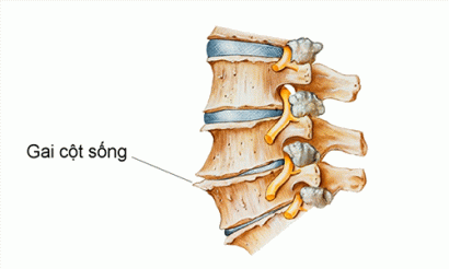 Phương Pháp Chữa Bệnh Gai Cột Sống Hiệu Quả