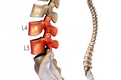 Chuẩn đoán và điều trị thoát vị đĩa đệm L4 L5 S1