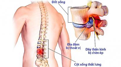 ĐIỀU TRỊ THOÁT VỊ ĐĨA ĐỆM CHỈ CẦN 20 PHÚT