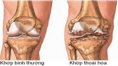 THOÁI HÓA KHỚP VÀ CÁCH ĐIỀU TRỊ HIỆU QUẢ