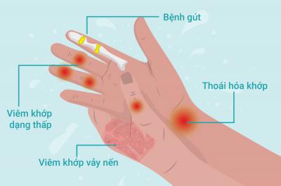 Tê Bì Chân Tay Là Bệnh Gì, Có Nguy Hiểm Không?