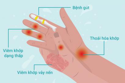 Tê Bì Chân Tay Là Bệnh Gì, Có Nguy Hiểm Không?